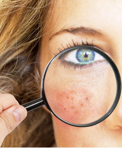 Acne & Blemishes: Holistic Alternatives to Pharmaceutical Drugs - Glimmer Goddess® Organic Skin Care
