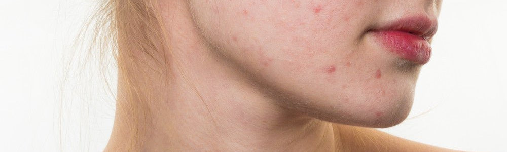 Acne and gut health guide reviewing diet, microbiome research and realistic expectations.