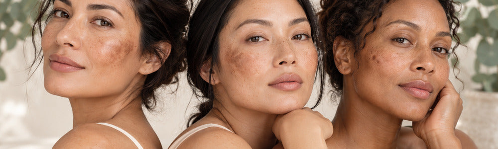Three women illustrating melasma, post-inflammatory marks and sun spots