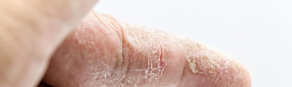 Close-up editorial image for a guide to asteatotic eczema, a dry and cracked skin condition.