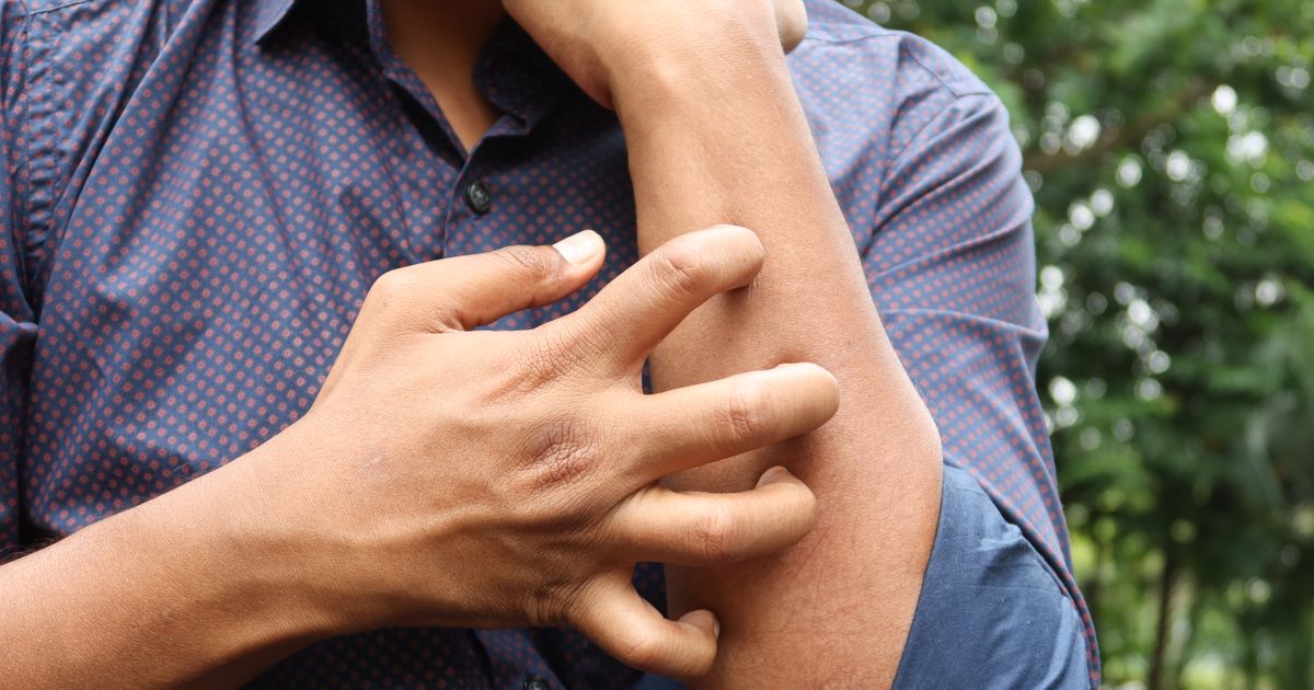 Eczema Flare Up Causes: 9 Common Triggers to Avoid