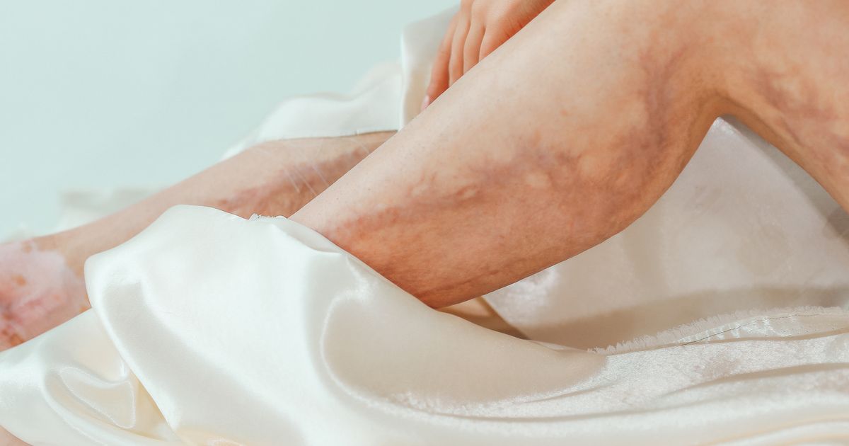 Best Skincare for Varicose Eczema: Soothe Irritated Legs