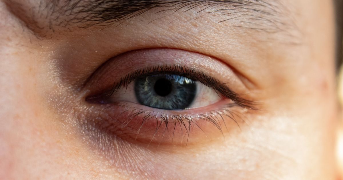 Eczema on Eyelids: Natural Cure & Relief Guide