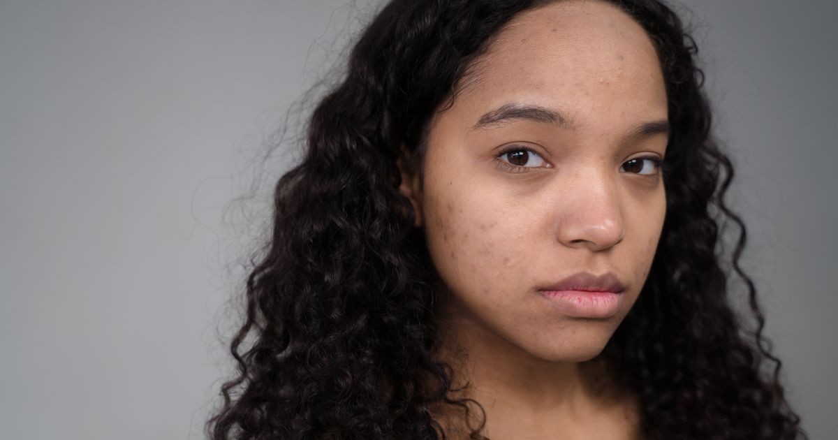 Best Products for Acne Scars & Dark Spots 2026: Top 6 Ranked