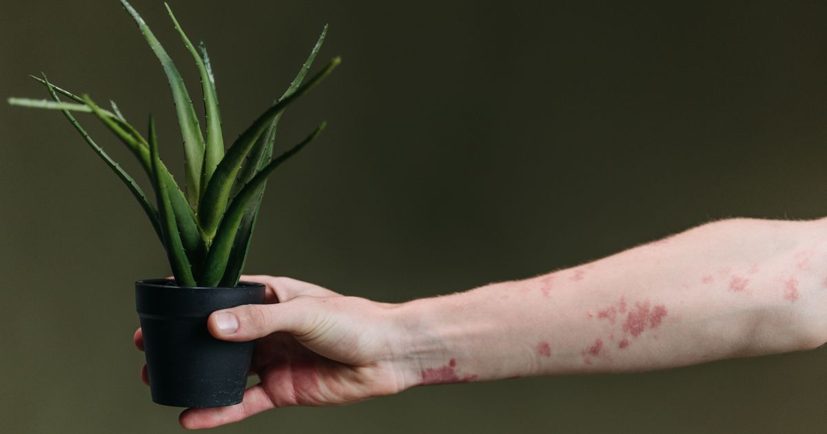 Can Eczema Spread? What You Need to Know