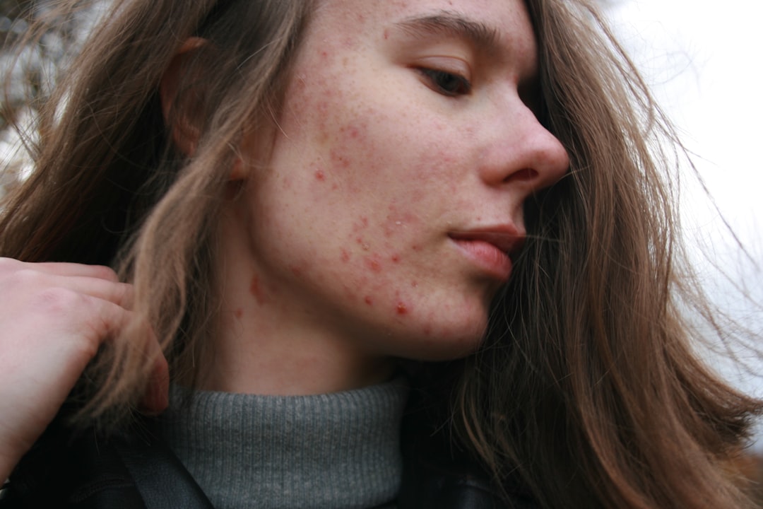 Eczema Rosacea Skincare Routine That Actually Works