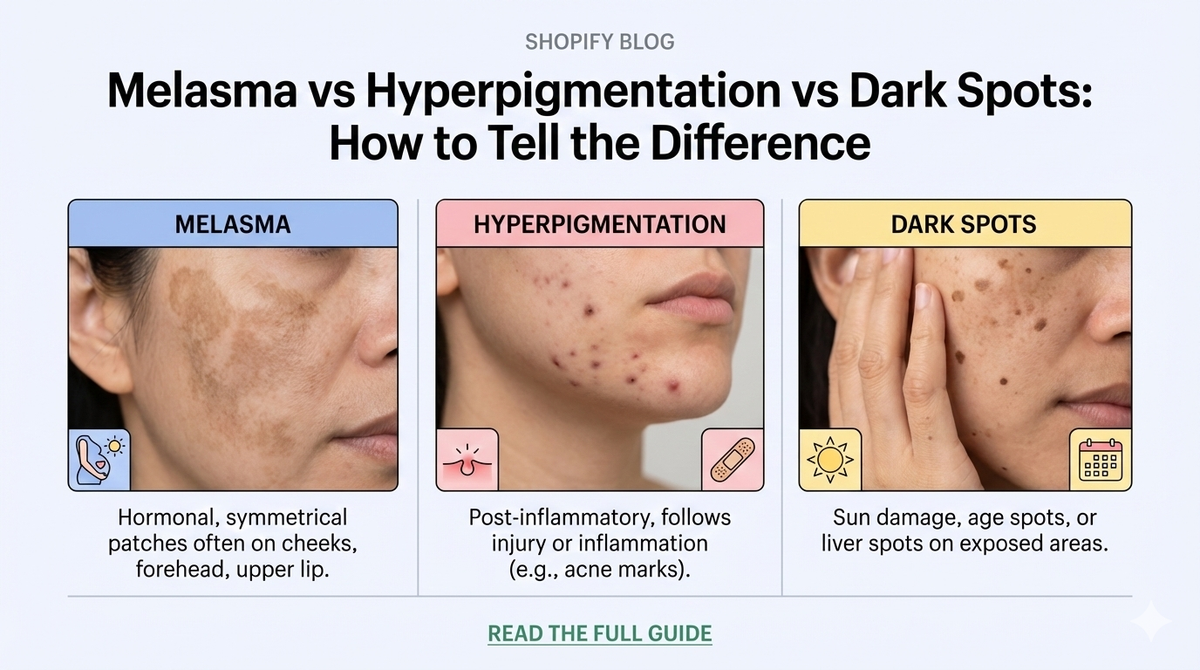 Melasma vs Hyperpigmentation vs Dark Spots: How to Tell the Difference