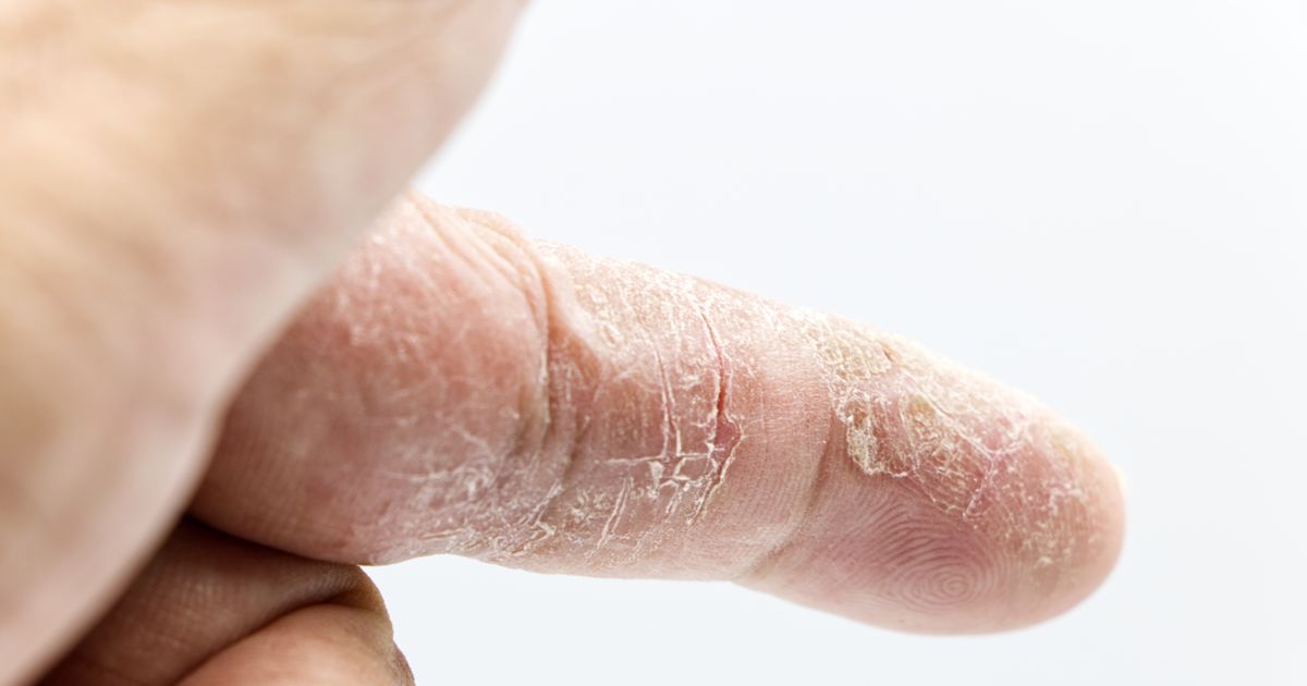 Asteatotic Eczema: Causes, Triggers & Natural Relief